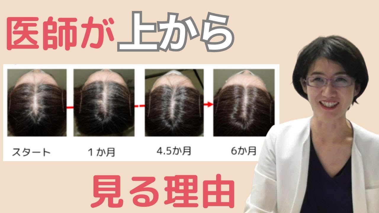 もう迷わない👉自分の育毛剤や薄毛対策が【効果でそうか】早めにわかる方法