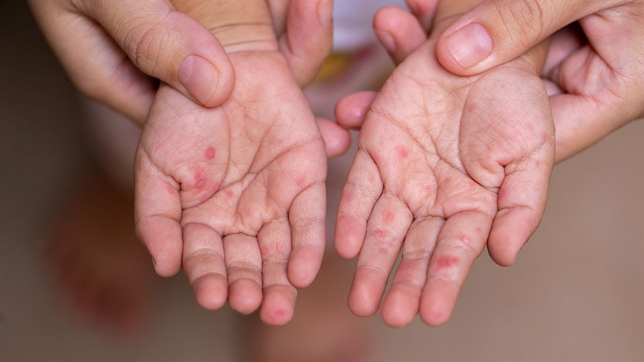 Hand, Foot and Mouth Disease - Akron Children's Hospital video