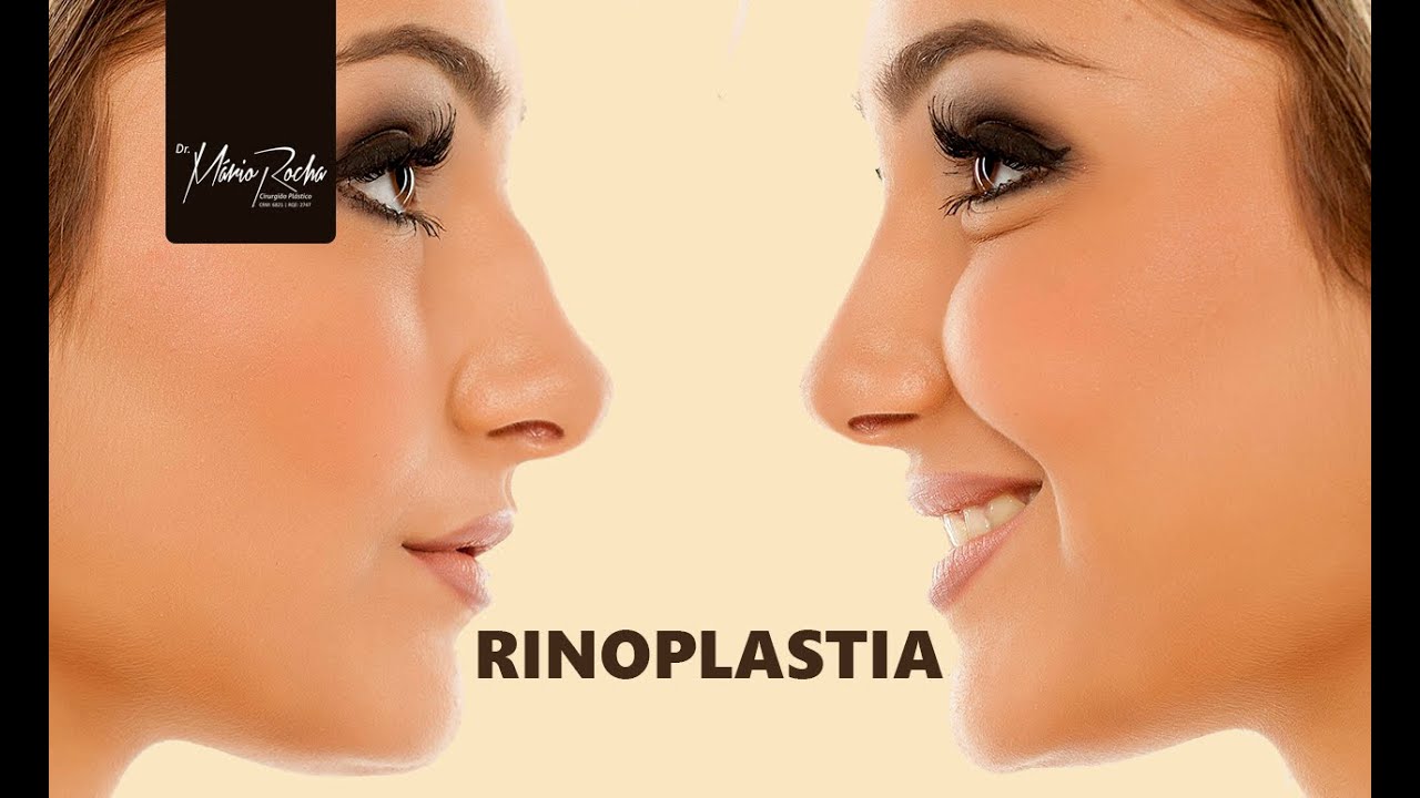 Rinoplastia - Cirurgia Plástica do nariz com  Dr. Mário Rocha