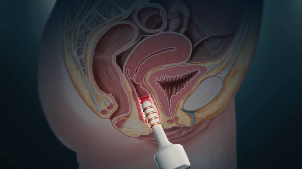 EVA™ uses Vaginal Dynamic Radiofrequency