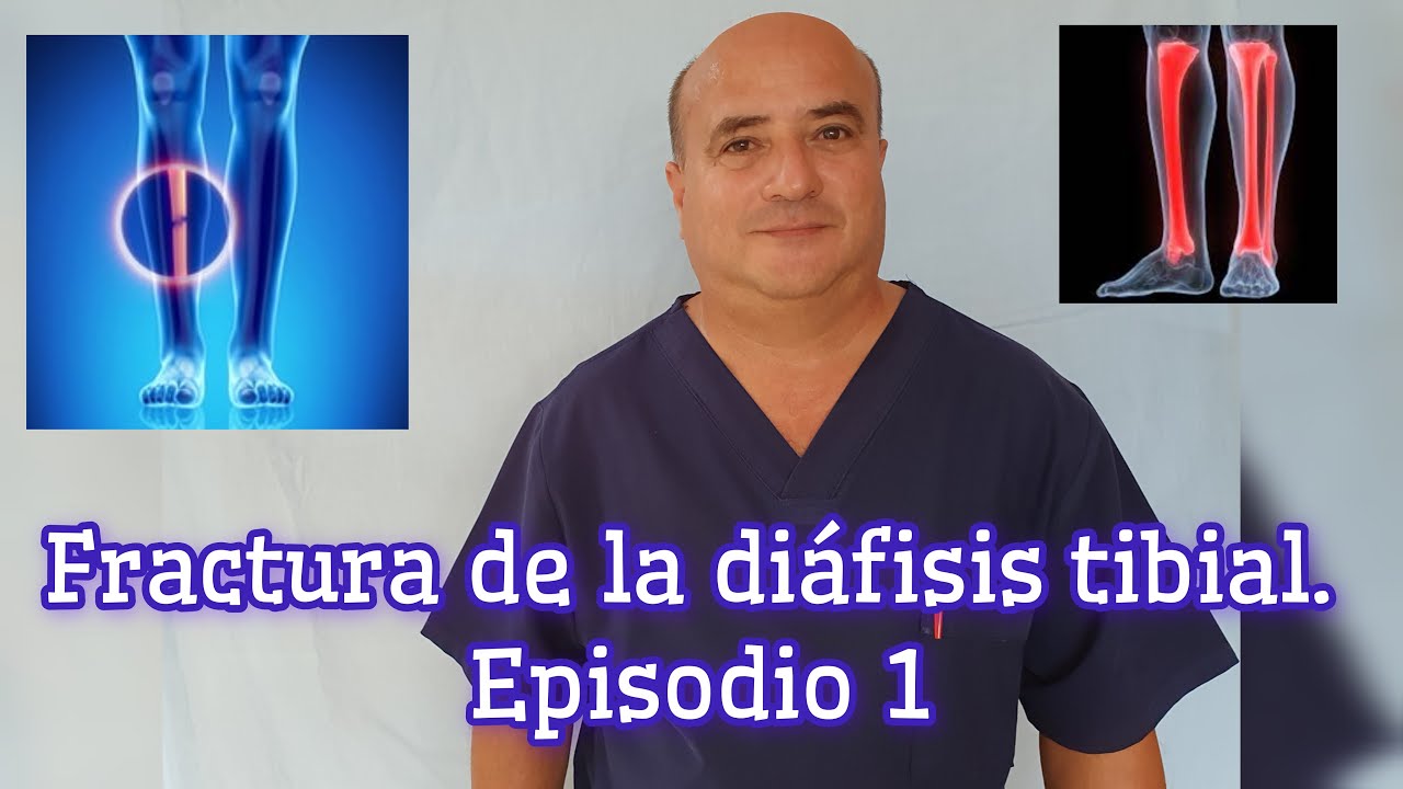 Fractura de la diáfisis tibial. Episodio 1