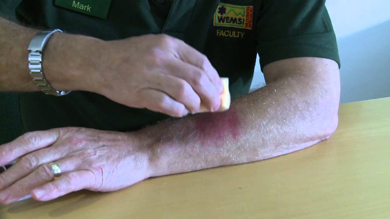 WEMSI: Making bruises and scrapes
