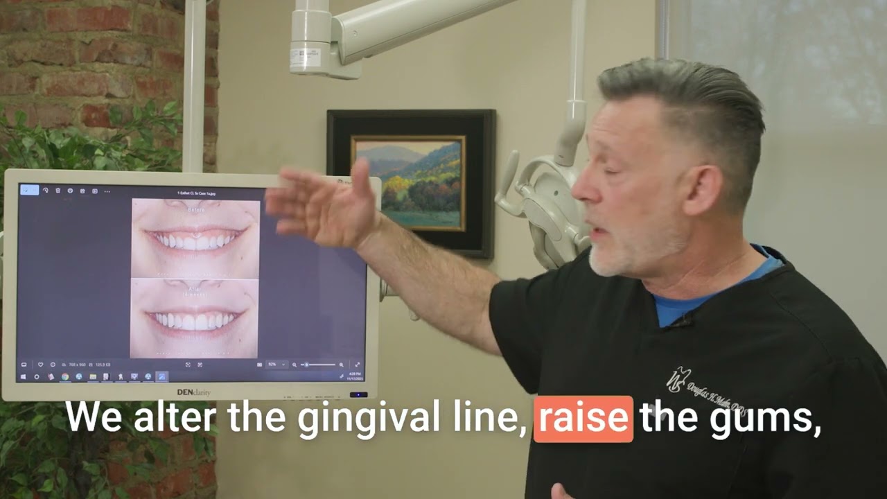 Crown Lengthening: The Most Common Diagnostic Mistake in Cosmetic Smile Treatment (Case Study)
