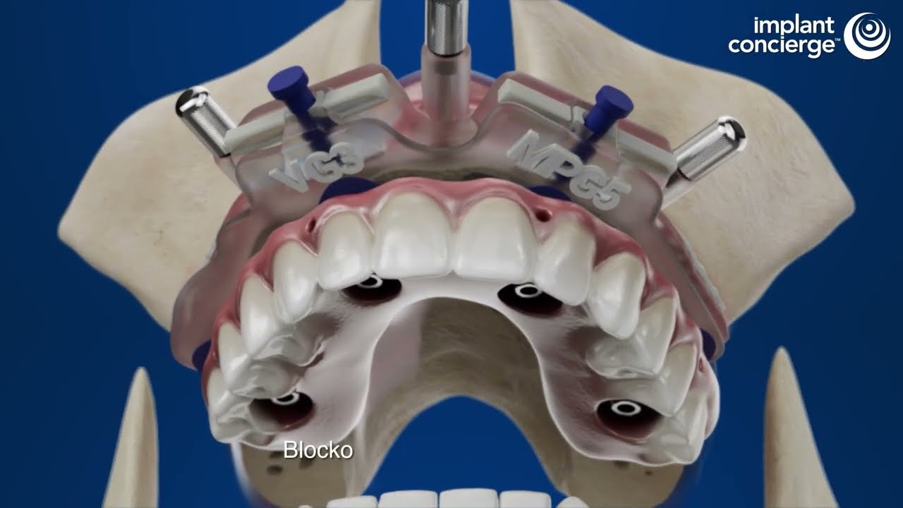 Implant Concierge: Bone Reduction Guide Technical Step-by-Step with Passive Fit Bridge