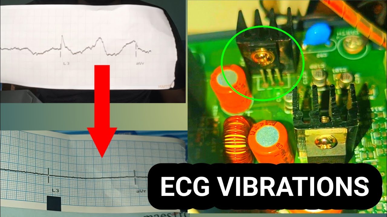 ECG Vibrations Issue Solved
