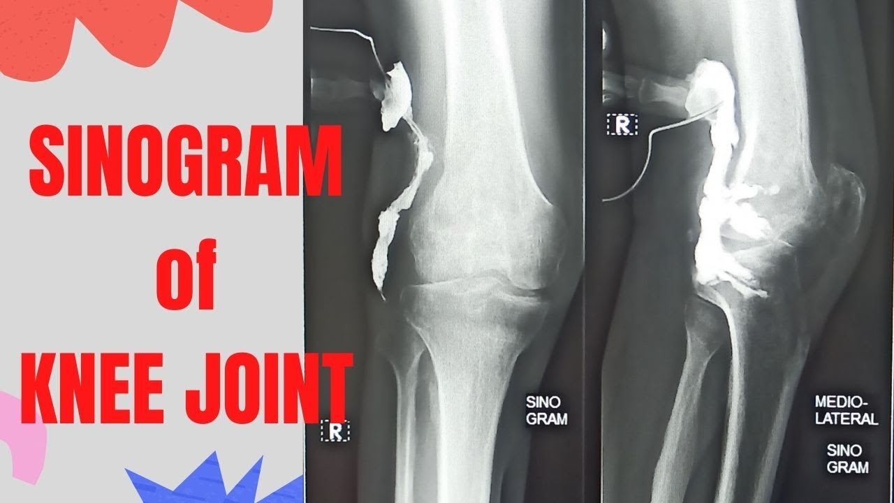 Technique  Sinogram of  knee joint (Ep-62) | knee joint sinography | sinogram procedure
