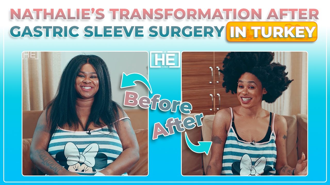 Nathalie&rsquo;s Transformation After Gastric Sleeve in&nbsp;Turkey | Dr HE Obesity Clinic