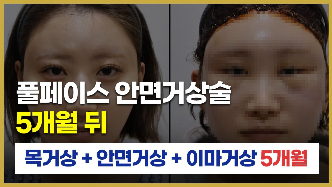 풀페이스 안면거상술 5개월 후기, 어떻게 변했을까요?