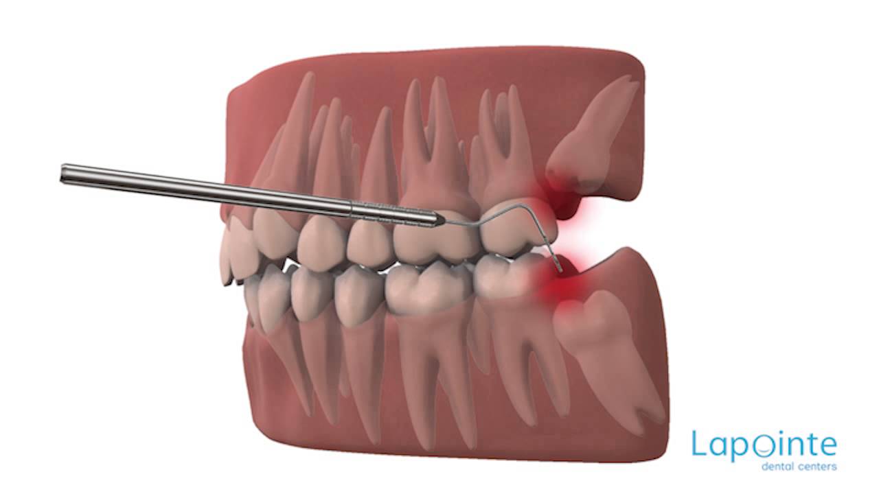 Wisdom teeth - Lapointe dental centres