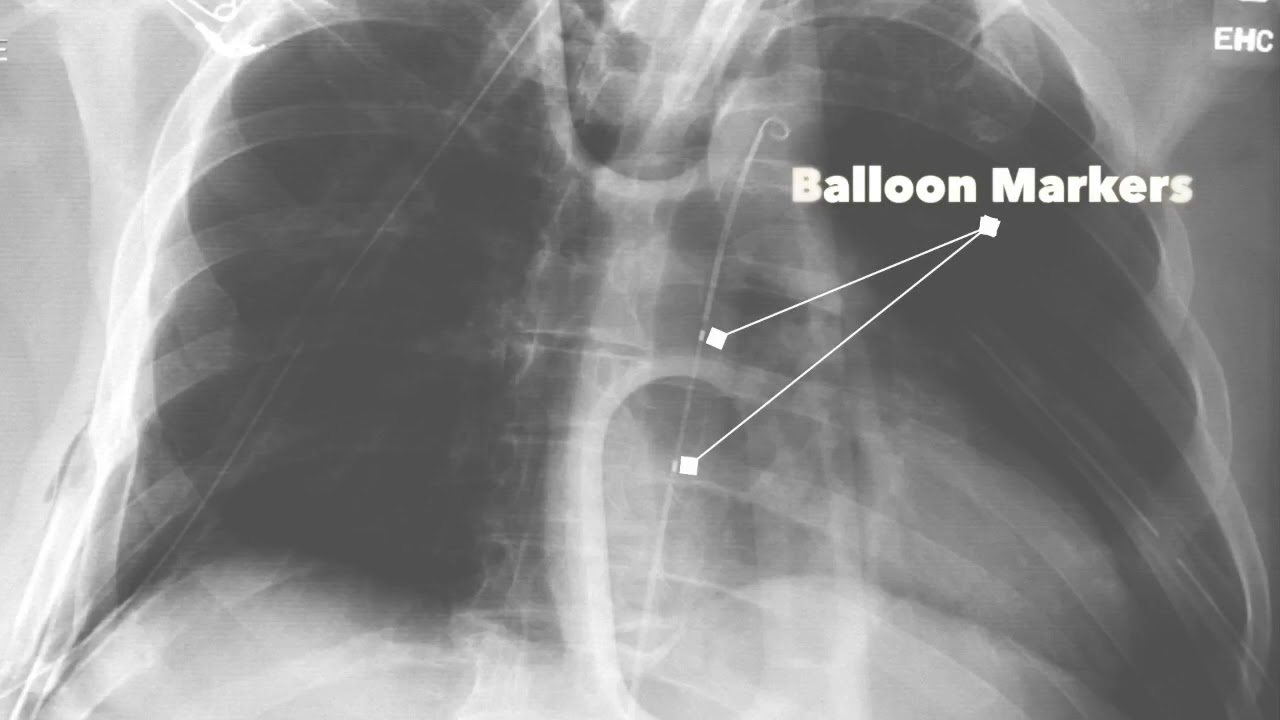 Trauma In A Flash: REBOA Technique