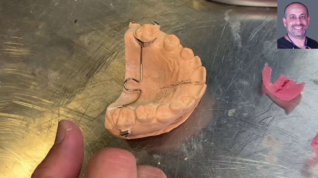 F021: TPA transpalatal arch and soldering orthodontic laboratory step  (braces Tx)