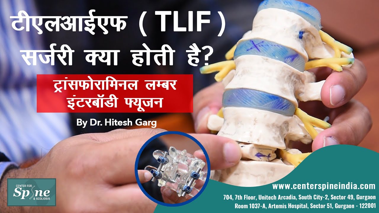 What is TLIF Surgery (Transforaminal Lumbar Interbody fusion) - In Hindi | TLIF Back Surgery