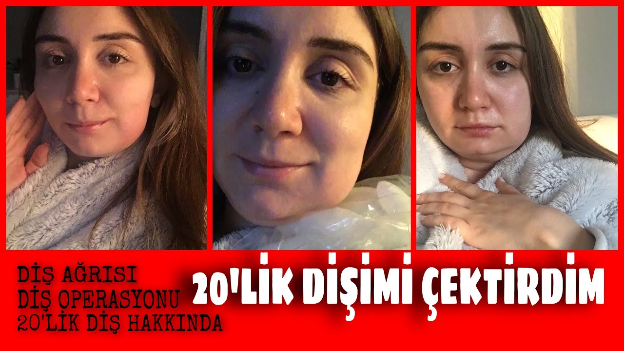 20’LİK DİŞİMİ ÇEKTİRDİM | DİŞ AMELİYATI #20likdiş #dişçektirme