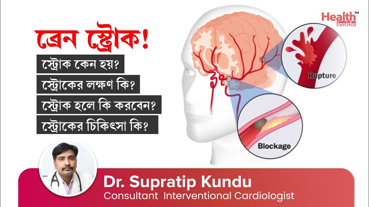 ব্রেন স্ট্রোক এর কারণ, লক্ষণ ও চিকিৎসা কি? | Stroke - Causes, Symptoms and Treatment Options
