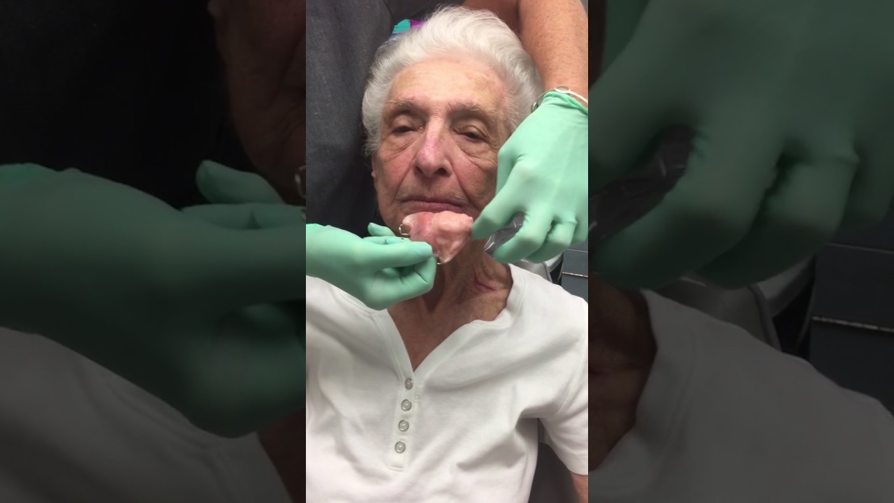 Life after cancer surgery to the hard palate. Reconstructed by an obturator.