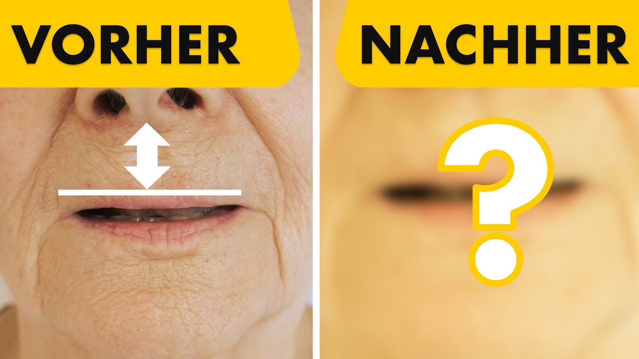 Bullhorn-Lift bei der Frau! Ich zeige 2 Patienten Beispiele | Dr. Jungwirth - Plastische Chirurgie