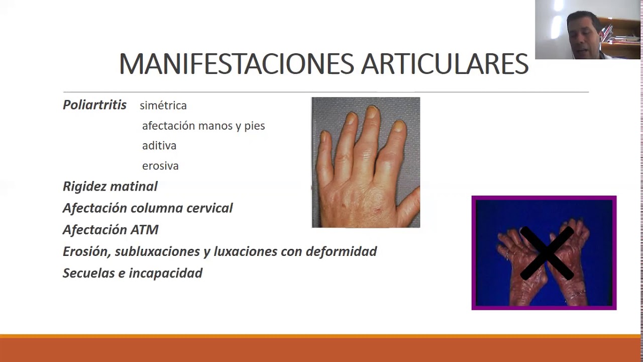 Artritis reumatoide