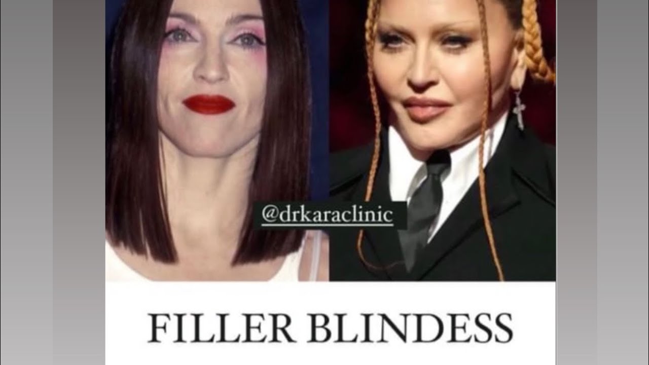 Madonna | Then & Now | Celebrity Aesthetics Dermal Filler Blindness