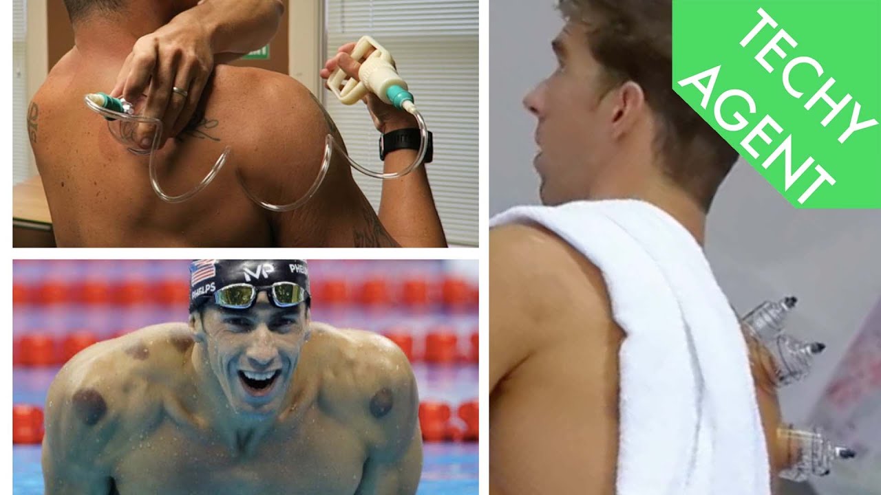 Cupping Technology Explained and REVIEWED