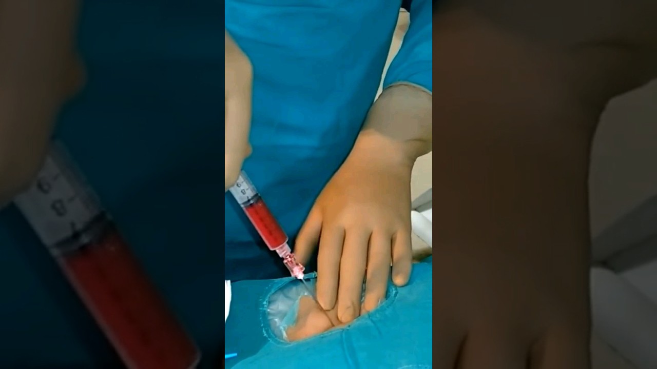 Varicocele embolization live case - Step 1 | Dr. Gaurav Gangwani