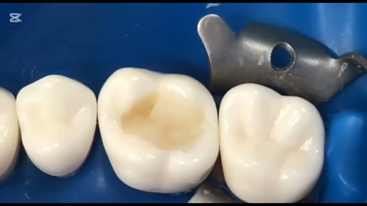 Class I Composite Restoration on Upper 6 (Short video)