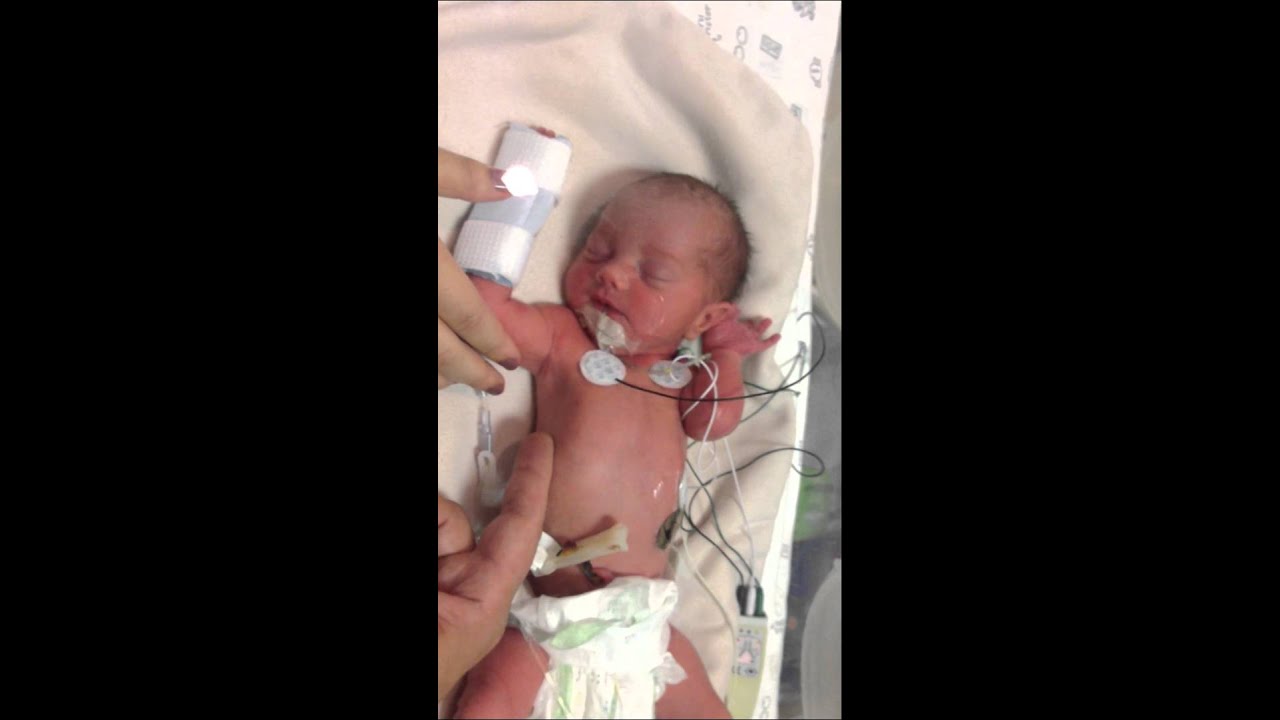 32 week preemie baby on day 2