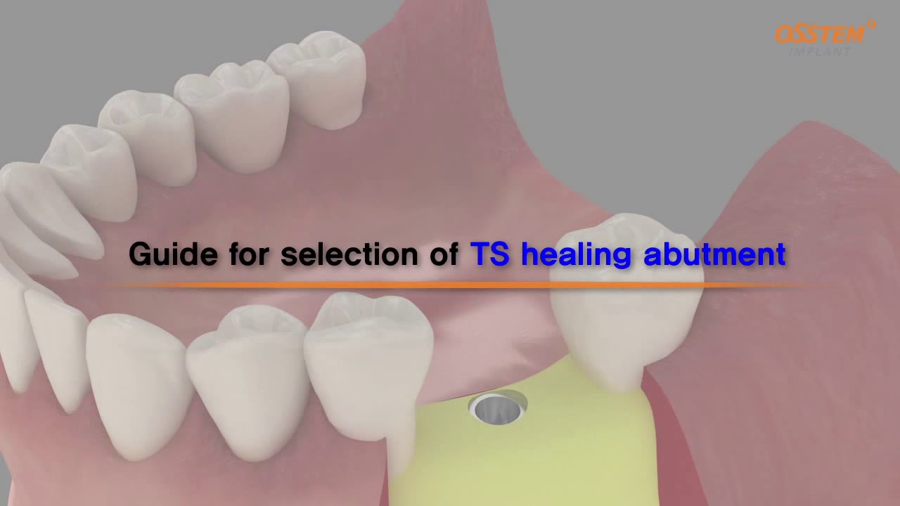 TSIII Rigid Abutment