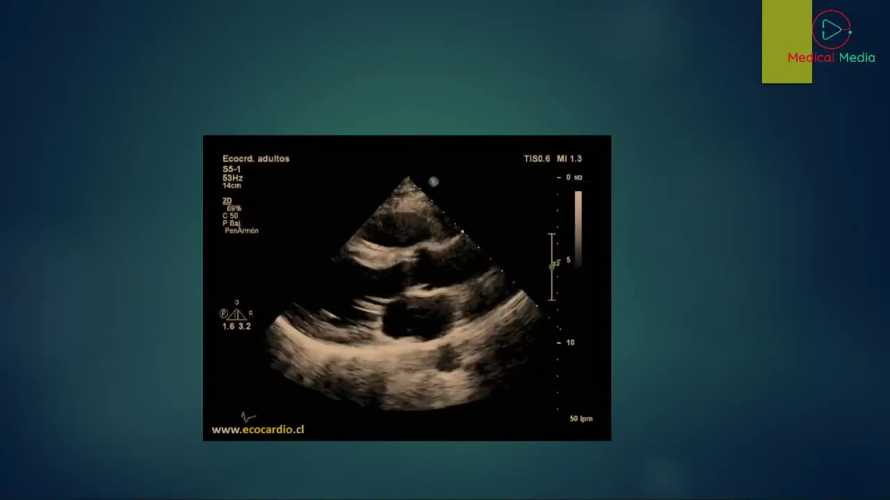 Patent Ductus Arteriosus