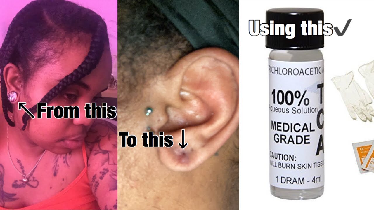 How I closed my stretched ears without surgery (must watch)