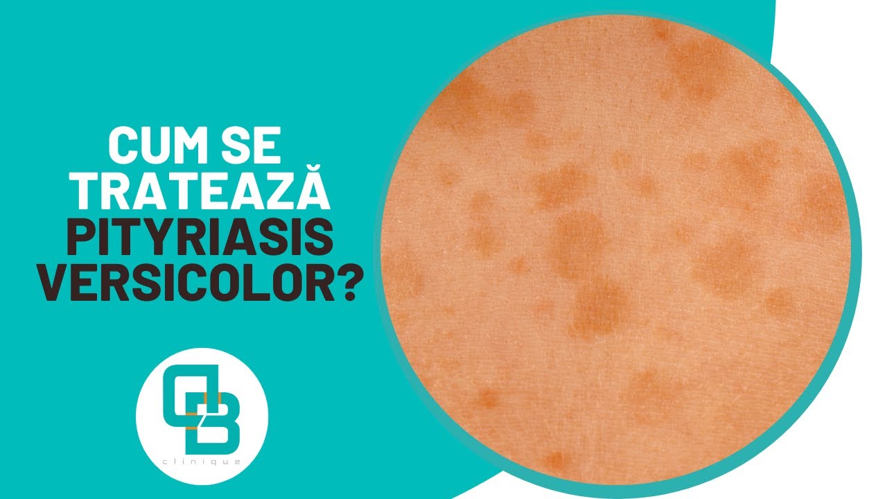 Tratament pentru Pitiriazisul versicolor (pityriasis versicolor) | DermaBeauty Clinique