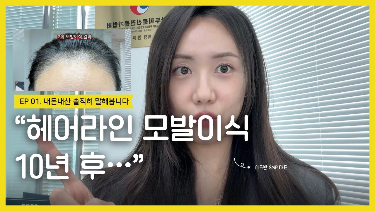 헤어라인 모발이식 10년 후 솔직히 말해봅니다 (내돈내산)