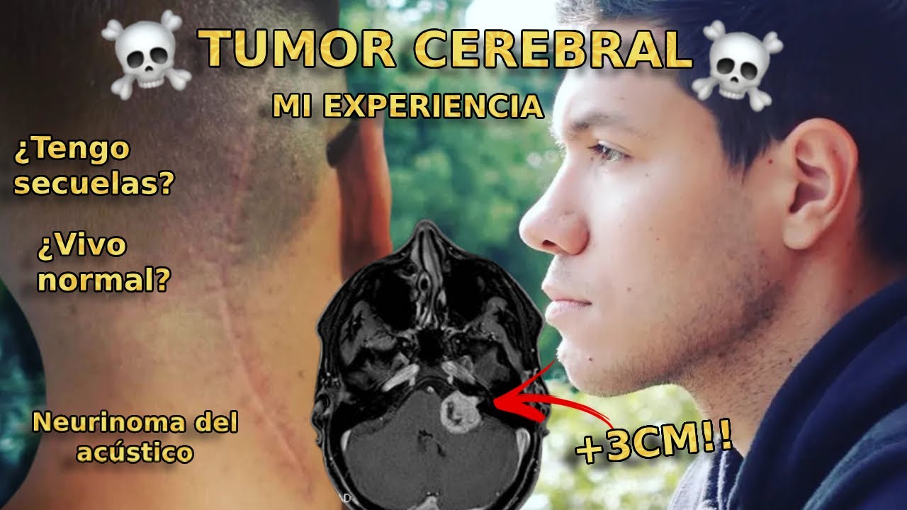 MI EXPERIENCIA:🧠 TUMOR CEREBRAL ☠️(NEURINOMA DEL ACÚSTICO) | DIAGNOSTICO | RECUPERACIÓN | SECUELAS.