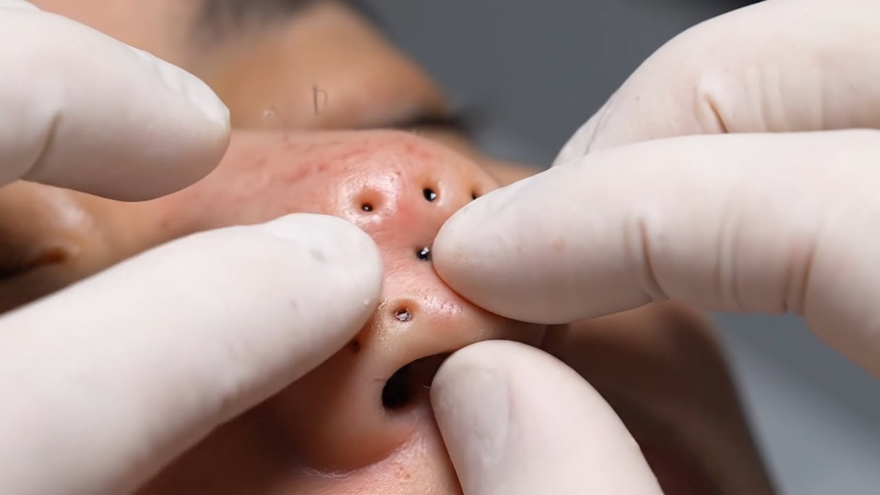 Nose Blackhead Removal &mdash; Extreme Macro Extractions