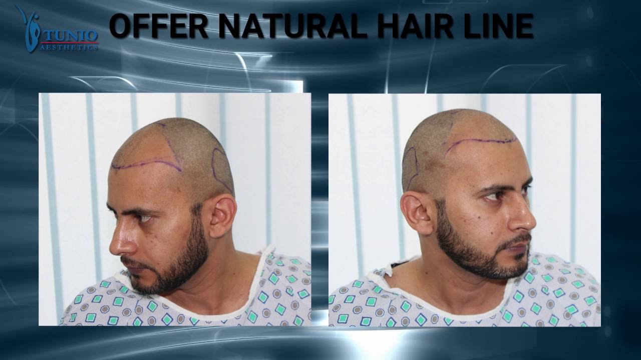 FUE hair transplant before and after results & procedure steps - Tunio Aesthetics