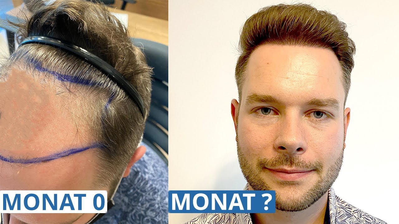 Haarwachstum nach einer Haartransplantation | Monat für Monat