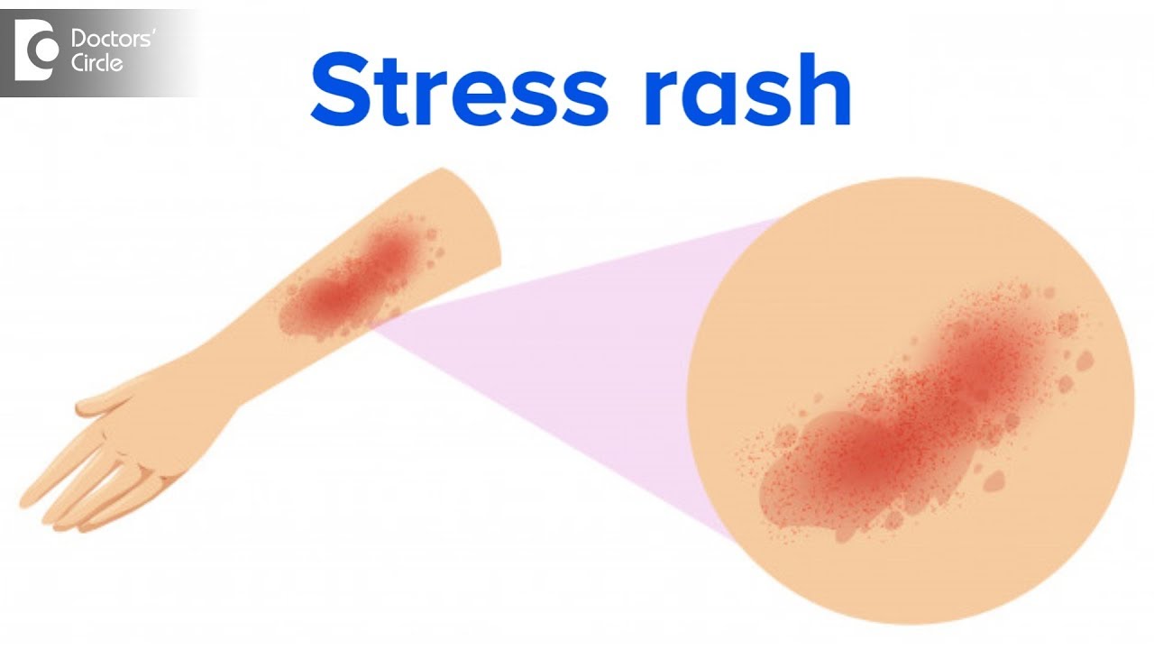 What is a stress rash? - Dr. Rajdeep Mysore