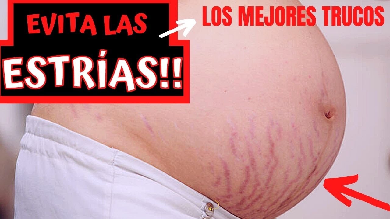 📢 Los mejores trucos para evitar estrías en el embarazo 🤰🏻