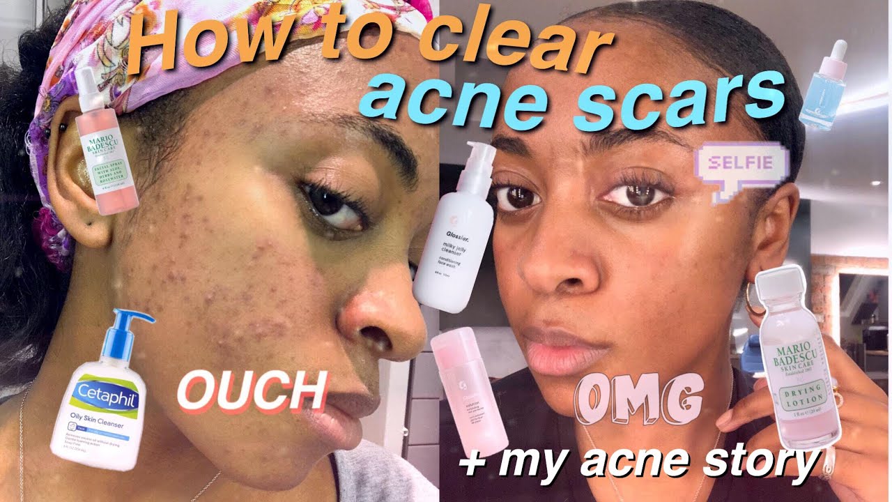How to Clear Acne Scars | Epiduo Review + Tips