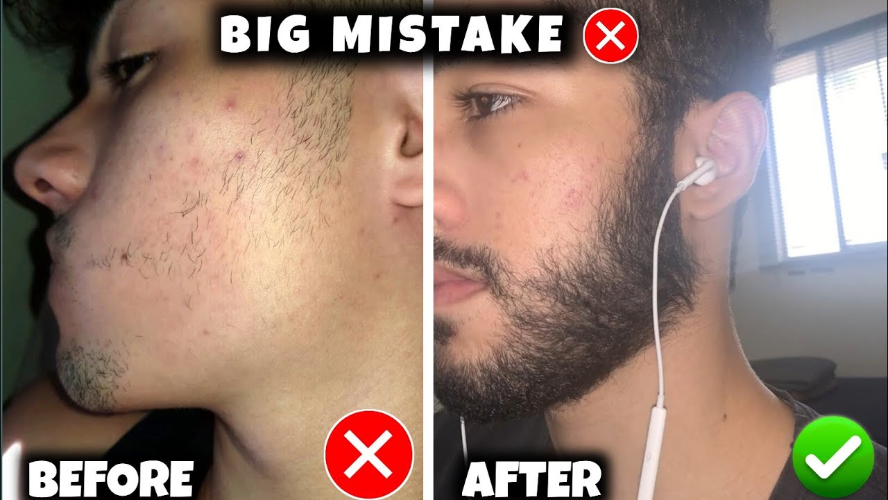 ये गलती कभी भी दाढ़ी नहीं आने देगी | minoxidil big mistake for beard growth 2026 |