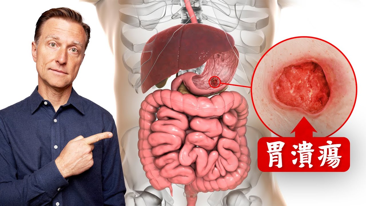 潰瘍最快自然療法,柏格醫生 Dr Berg