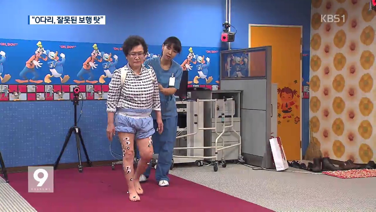 &lsquo;O다리&rsquo; 원인 규명&hellip;&ldquo;발 모아 걷지 마세요&rdquo;