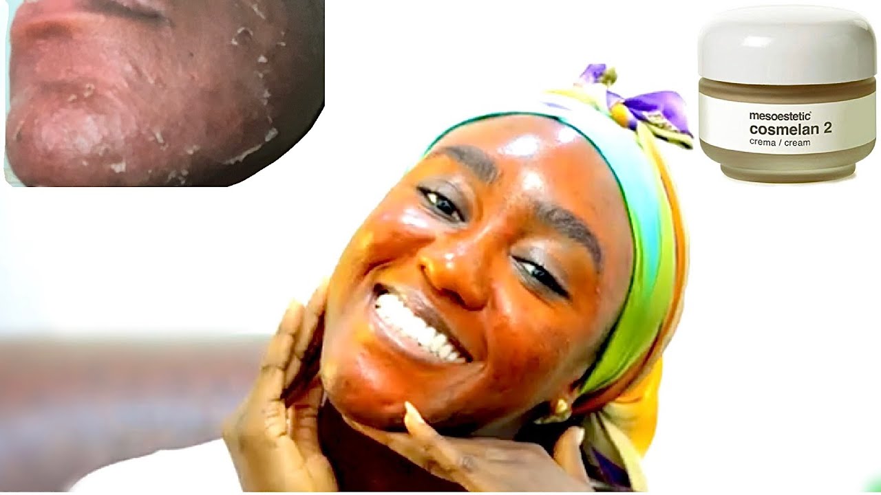 COSMELAN PEEL on Black Skin for Hyperpigmentation and Acne Scars | Full Peeling Process + Review