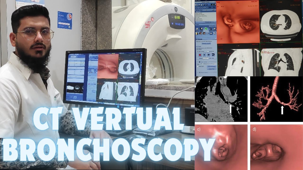 CT Vertual Bronchoscopy Post Processing/ Filming Process #radiology