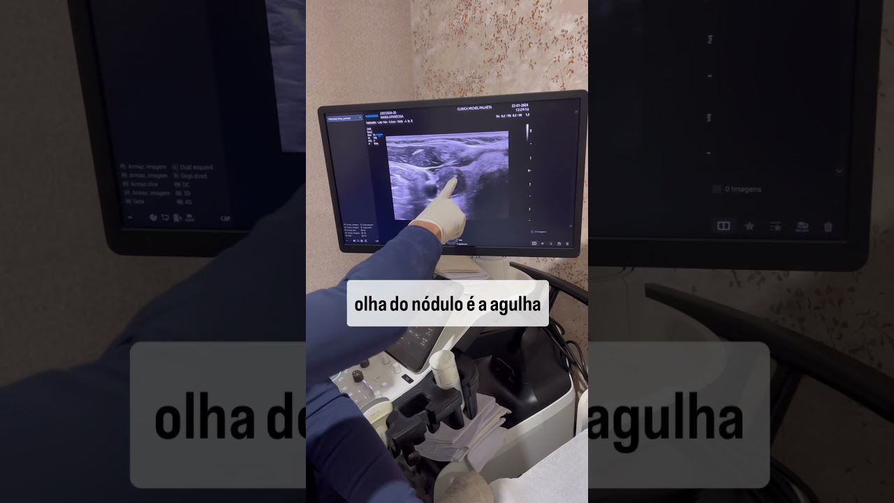 Veja como &eacute; feita a Pun&ccedil;&atilde;o de n&oacute;dulo da tireoide