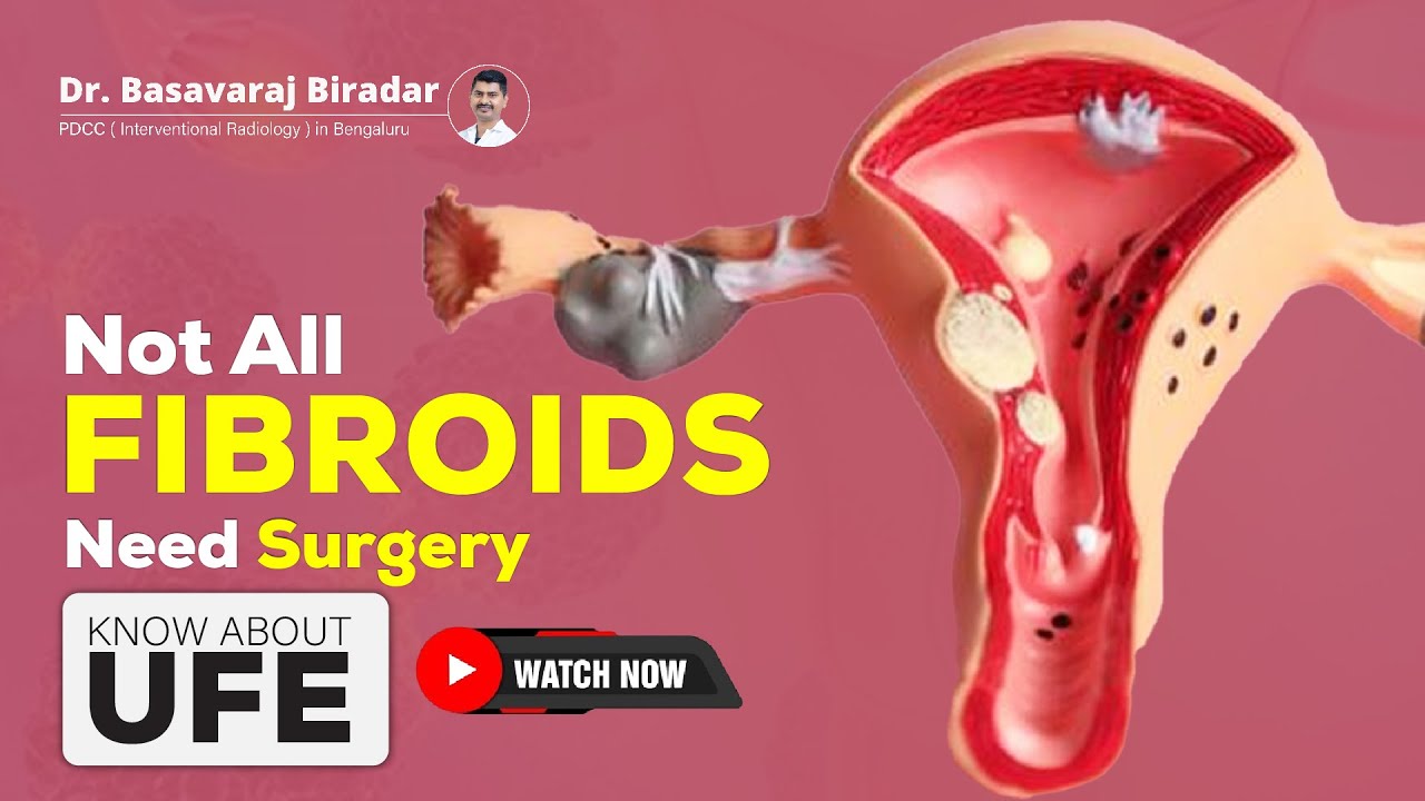 What Is Uterine Fibroid Embolization? Fibroid Treatment Without Surgery in #bangalore #womenshealth 