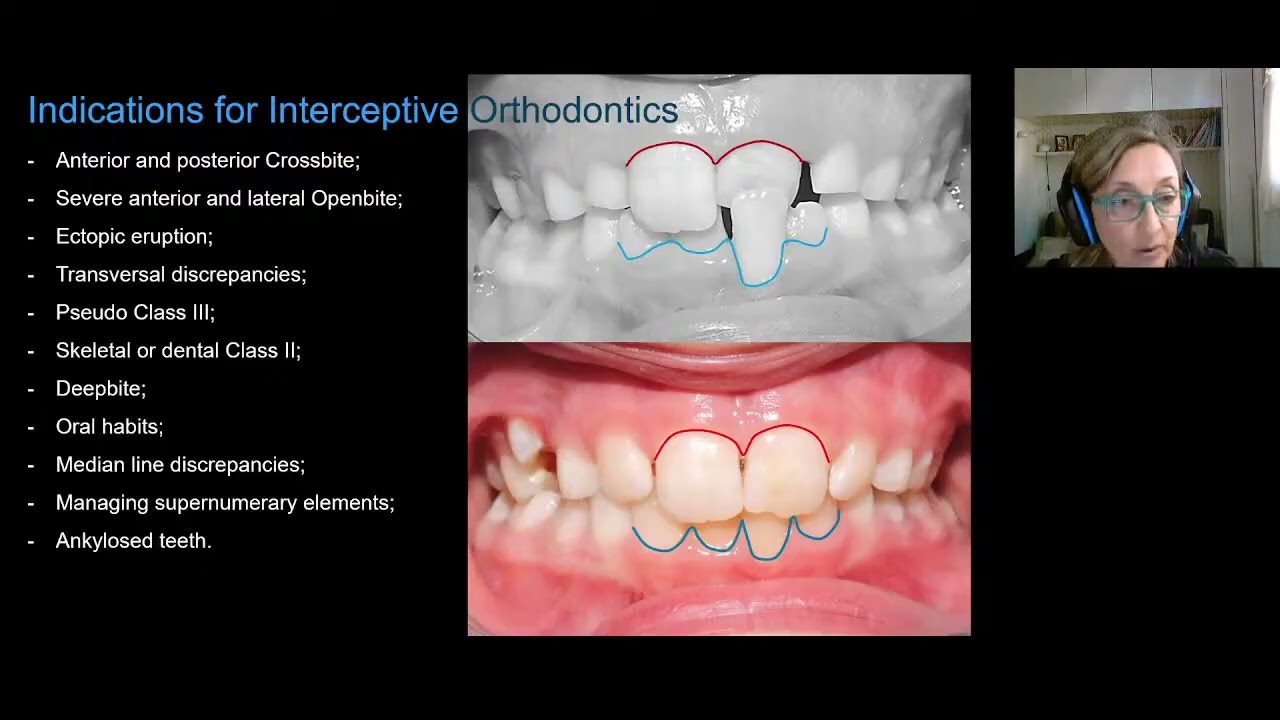 11  Diagnostic and therapeutic approach with aligners in growing subjects