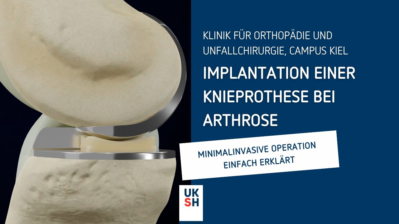 Kniegelenkersatz: Minimalinvasive Operation einfach erkl&auml;rt