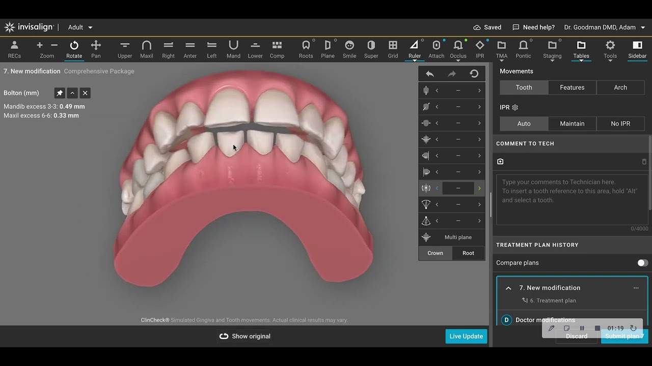 DO THIS, when you are developing your Invisalign clincheck
