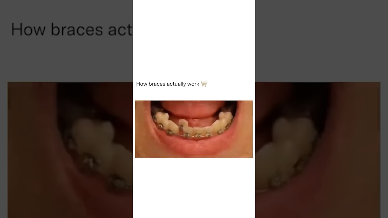 Dentist Reveals Secret That Could Save You 4 Teeth! 🦷😬