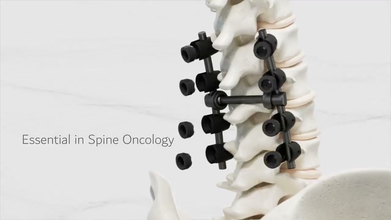 Carbofix: Carbofix Spine System